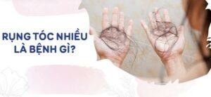 Rụng tóc nhiều là bệnh gì